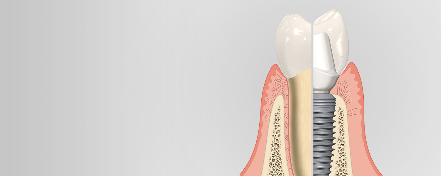 Bone Grafting Covered Insurance Bone Grafting Oral Bone Grafting Covered Insurance Bone Grafting Oral